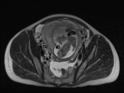 Closed loop small bowel obstruction in pregnancy (MRI) (Radiopaedia 87637-104031 D 26).jpg