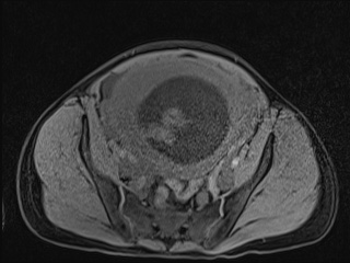 Closed loop small bowel obstruction in pregnancy (MRI) (Radiopaedia 87637-104031 F 43).jpg