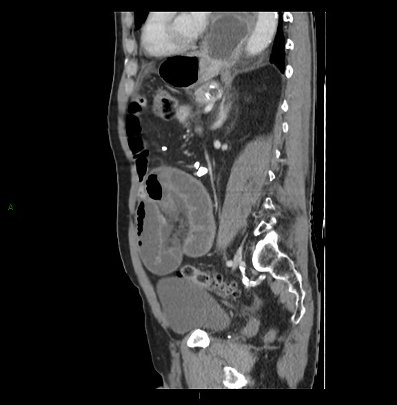 File:Closed loop small bowel obstruction with ischemia (Radiopaedia 84180-99456 C 58).jpg