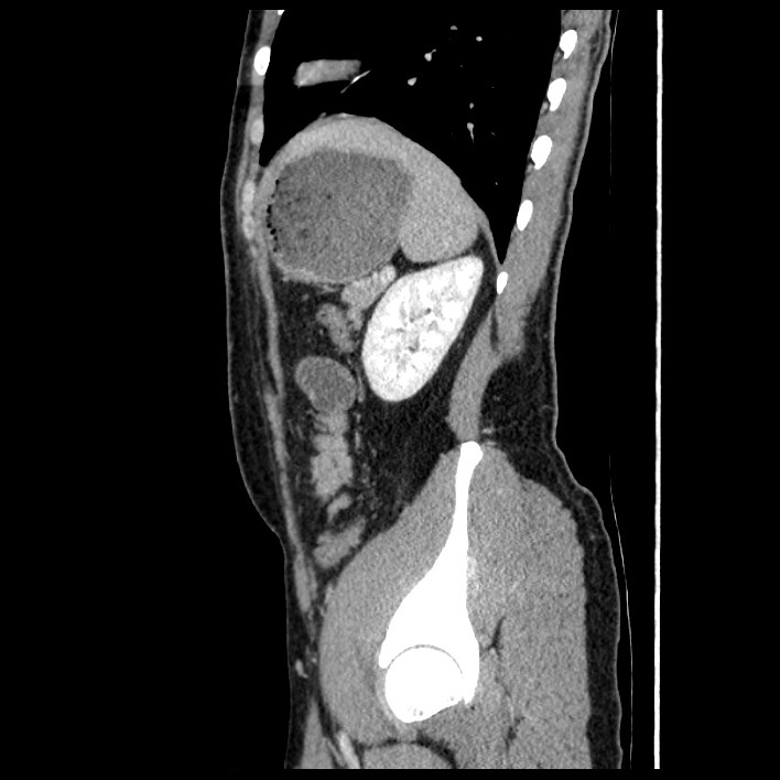 Co-existing acute appendicitis and epiploic appendagitis (Radiopaedia 61789-69911 B 74).jpg