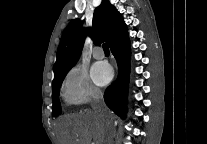 Coarctation of aorta with aortic valve stenosis (Radiopaedia 70463-80574 B 19).jpg