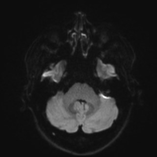 File:Cochlear incomplete partition type III associated with hypothalamic hamartoma (Radiopaedia 88756-105498 Axial DWI 50).jpg