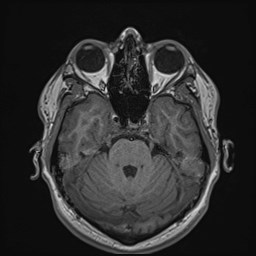 File:Cochlear incomplete partition type III associated with hypothalamic hamartoma (Radiopaedia 88756-105498 Axial T1 70).jpg