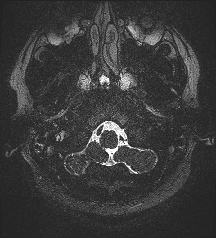 Cochlear incomplete partition type III associated with hypothalamic hamartoma (Radiopaedia 88756-105498 Axial T2 15).jpg