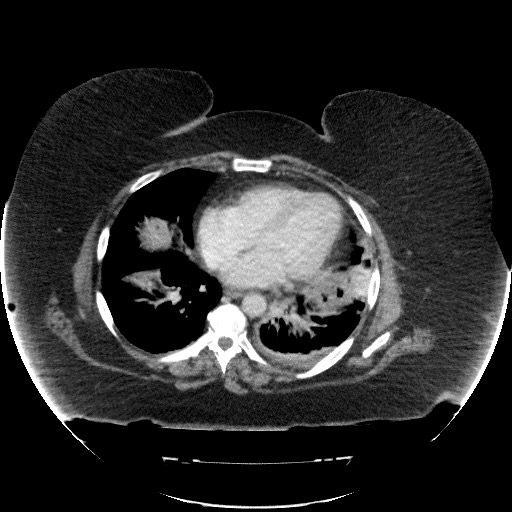 File:Collection due to leak after sleeve gastrectomy (Radiopaedia 55504-61972 A 9).jpg