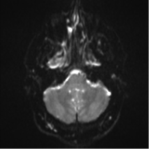 File:Colloid cyst (Radiopaedia 44510-48181 Axial DWI 6).png