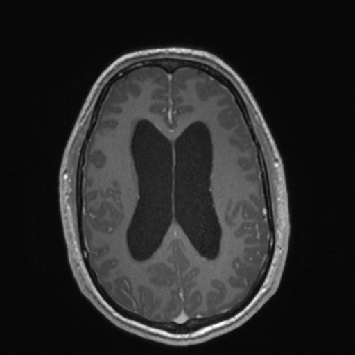 File:Colloid cyst (Radiopaedia 44510-48181 Axial T1 C+ 117).png