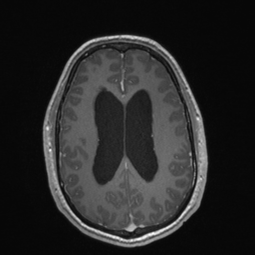 File:Colloid cyst (Radiopaedia 44510-48181 Axial T1 C+ 120).png