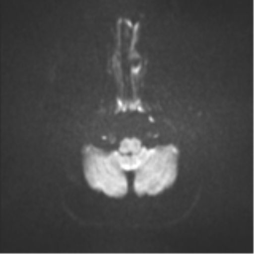 File:Colloid cyst (Radiopaedia 53164-59125 Axial DWI 31).png