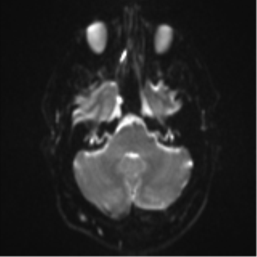 File:Colloid cyst (Radiopaedia 53164-59125 Axial DWI 7).png