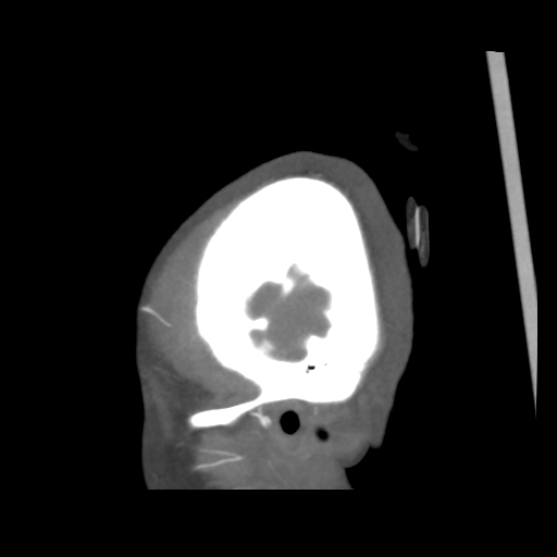 Colloid cyst (resulting in death) (Radiopaedia 33423-34499 B 2).png