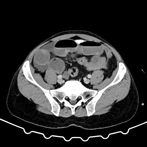Colocolic intussusception due to large lipoma (Radiopaedia 68773-78482 A 142).jpg
