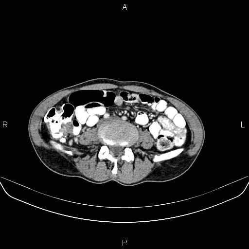 Colon adenocarcinoma - hepatic flexure (Radiopaedia 85635-101395 A 57).jpg