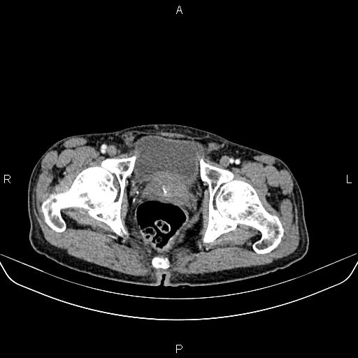 Colon adenocarcinoma - hepatic flexure (Radiopaedia 85635-101395 A 94).jpg