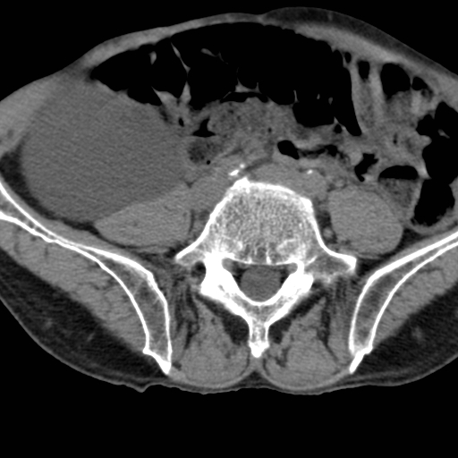 Colon cancer with calcified liver metastasis (Radiopaedia 74423-85309 Axial non-contrast 73).jpg