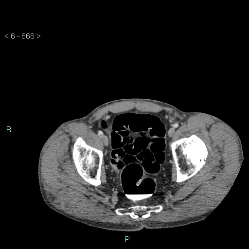 File:Colonic cancer (ultrasound and TC imaging) (Radiopaedia 50346-55713 A 127).jpg