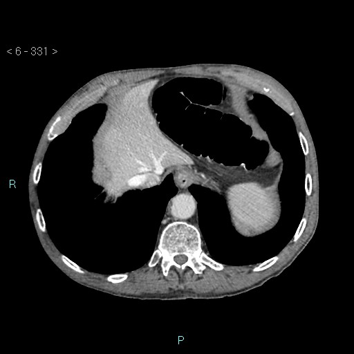Colonic cancer (ultrasound and TC imaging) (Radiopaedia 50346-55713 B 331).jpg