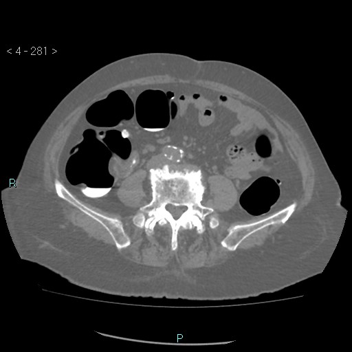 Colonic lipomas (Radiopaedia 49137-54244 Axial bone window 125).jpg
