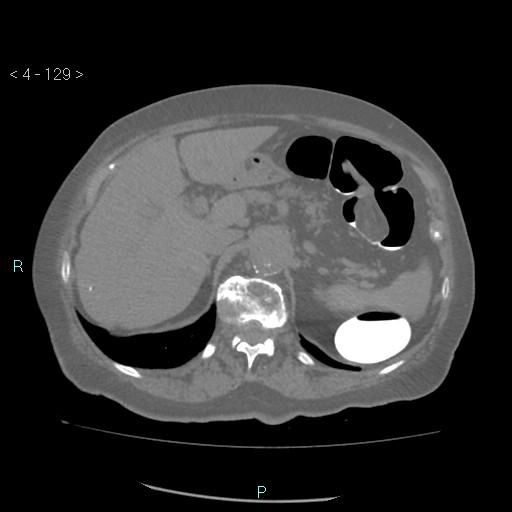 Colonic lipomas (Radiopaedia 49137-54244 Axial bone window 57).jpg