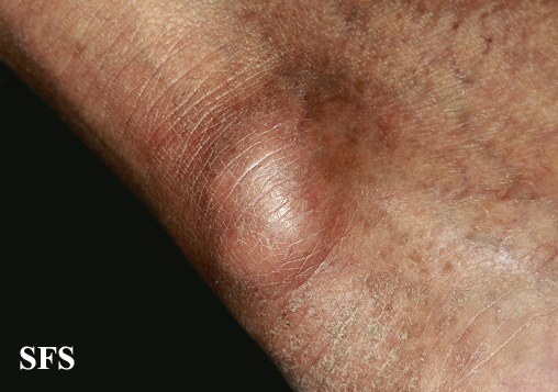 File:Gout (Dermatology Atlas 4).jpg