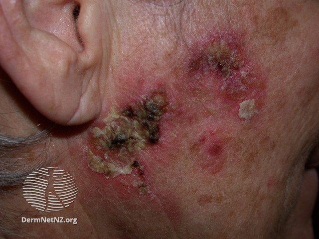 File:Intraepidermal carcinoma (DermNet NZ lesions-scc-in-situ-2960).jpg
