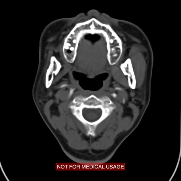 File:Nasopharyngeal carcinoma recurrence - skull base destruction (Radiopaedia 29107-29491 A 15).jpg