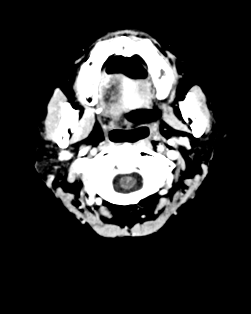 Nasopharyngeal carcinoma with cerebral abscess (Radiopaedia 43018-46275 Axial C+ delayed 2).png