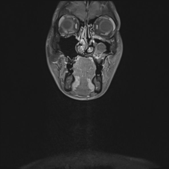 Nasopharyngeal carcinoma with skull base invasion (Radiopaedia 53415-59485 E 35).jpg
