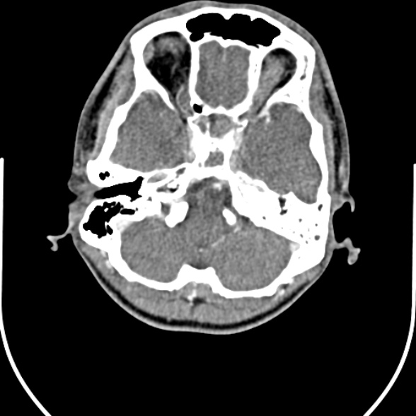 Nasopharyngeal carcinoma with skull base invasion (Radiopaedia 53415-59705 A 12).jpg