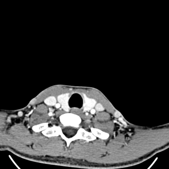 Nasopharyngeal carcinoma with skull base invasion (Radiopaedia 53415-59705 A 175).jpg