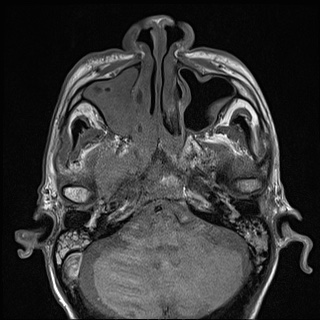 Nasopharyngeal carcinoma with skull base invasion (Radiopaedia 59258-66600 B 16).jpg