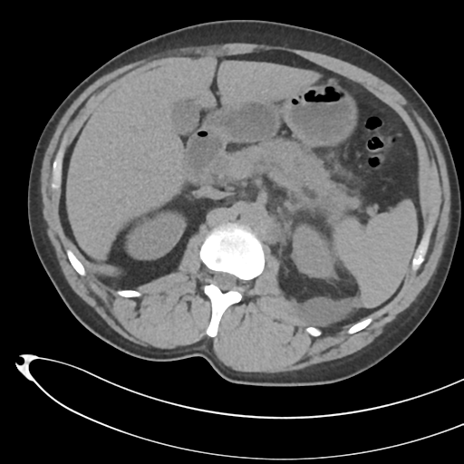 File:Necrotizing pancreatitis with acute necrotic collections (Radiopaedia 38829-41012 Axial non-contrast 29).png