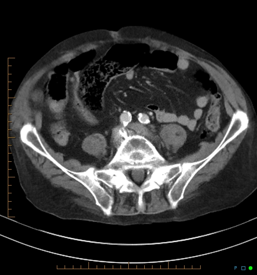 Necrotzing fasciitis due to a perforated adenocarcinoma of the splenic flexure (Radiopaedia 46930-51455 A 44).jpg
