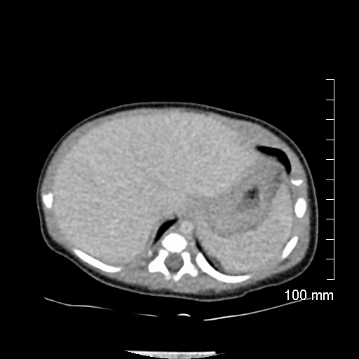 File:Neonatal neuroblastoma (Radiopaedia 56651-63438 Axial non-contrast 19).jpg