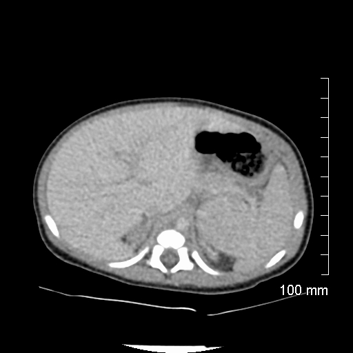 File:Neonatal neuroblastoma (Radiopaedia 56651-63438 Axial non-contrast 24).jpg