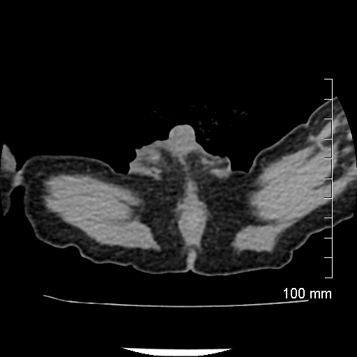 File:Neonatal neuroblastoma (Radiopaedia 56651-63438 Axial non-contrast 92).jpg