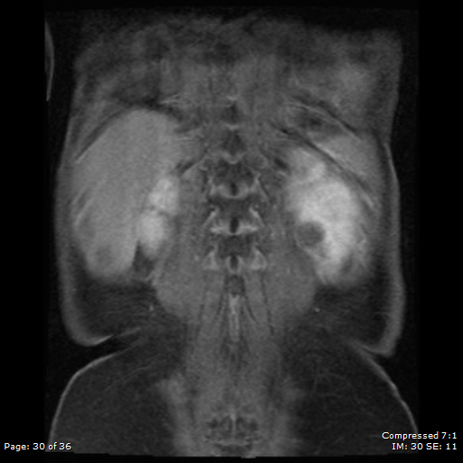File:Nephroblastomatosis (Radiopaedia 39984-42478 D 1).png