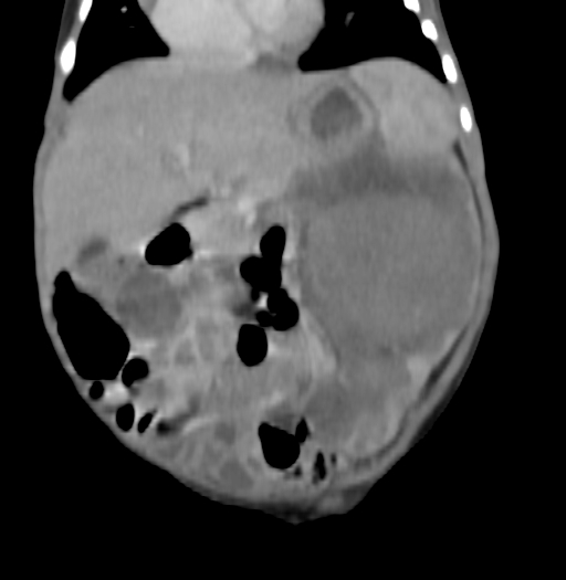 Nephroblastomatosis (Radiopaedia 71294-81607 B 159).jpg