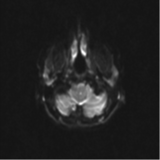 Neurenteric cyst (Radiopaedia 58641-65837 Axial DWI 5).png
