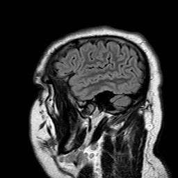 File:Neuro-Behcet's disease (Radiopaedia 21557-21506 Sagittal FLAIR 31).jpg