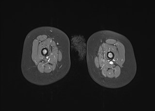 File:Neuroblastoma with bone metastases (Radiopaedia 67080-76414 Axial T1 C+ fat sat 29).jpg