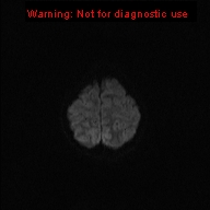 File:Neurofibromatosis type 1 with optic nerve glioma (Radiopaedia 16288-15965 Axial DWI 51).jpg
