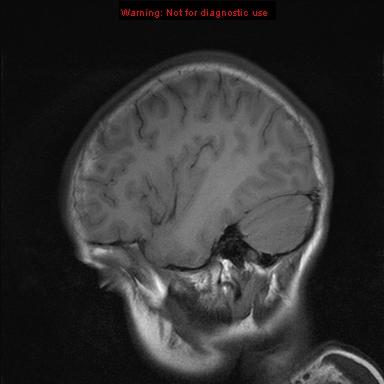 File:Neurofibromatosis type 1 with optic nerve glioma (Radiopaedia 16288-15965 Sagittal T1 19).jpg