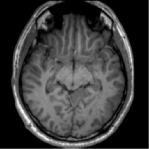 File:Neurofibromatosis type 2 (Radiopaedia 44936-48838 Axial T1 61).png