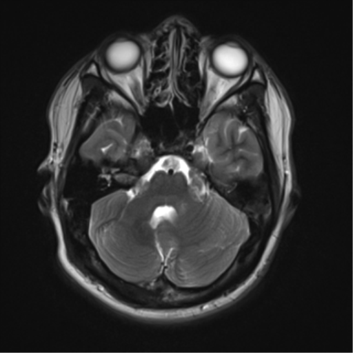 File:Neurofibromatosis type 2 (Radiopaedia 44936-48838 Axial T2 6).png