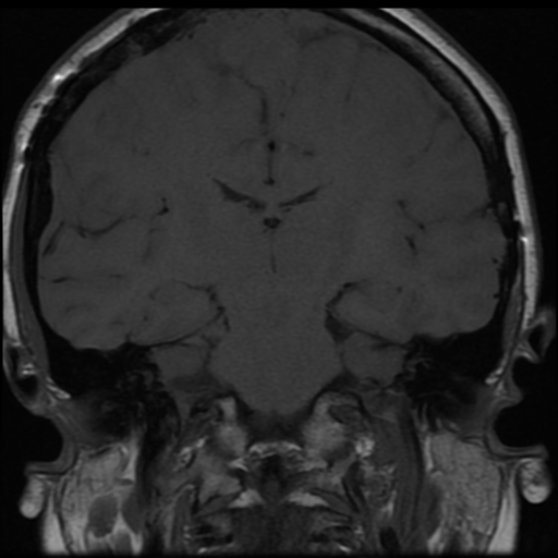 File:Neurofibromatosis type 2 (Radiopaedia 45229-49251 Coronal T1 6).png