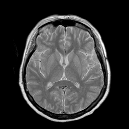 File:Neurofibromatosis type 2 (Radiopaedia 8713-9518 Axial Gradient Echo 12).jpg