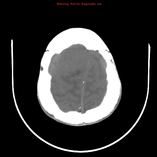 File:Neurofibromatosis type 2 (Radiopaedia 8953-9732 Axial non-contrast 28).jpg