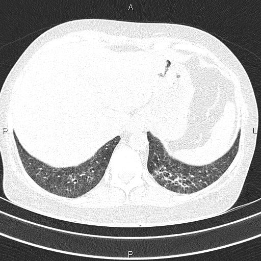 Non-specific interstitial pneumonia (Radiopaedia 83185-97567 Axial lung window 55).jpg