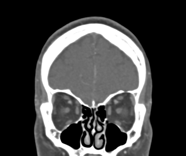 File:Normal CTA head (Radiopaedia 40801-43464 B 22).png